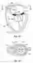 Fig. 15 - Translumenal apparatus, system, and method