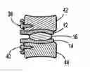 Fig. 01 - Cervical motion preservation device