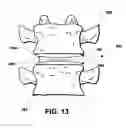 Fig. 11 - Intervertebral prosthetic disc and method of installing same