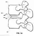 Fig. 12 - Intervertebral prosthetic disc and method of installing same