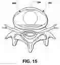 Fig. 13 - Intervertebral prosthetic disc and method of installing same