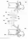 Fig. 01 - Intervertebral prosthetic disc