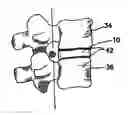 Fig. 01 - Artificial nucleus pulposus and method of injecting same