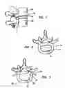 Fig. 02 - Artificial nucleus pulposus and method of injecting same