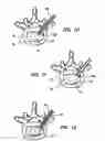 Fig. 05 - Artificial nucleus pulposus and method of injecting same