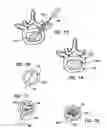 Fig. 06 - Artificial nucleus pulposus and method of injecting same
