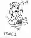Fig. 02 - Under arm/breast perspiration shields