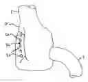 Fig. 01 - Methods and apparatus for revision of obesity procedures