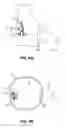 Fig. 09 - Methods and apparatus for revision of obesity procedures