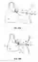 Fig. 13 - Methods and apparatus for revision of obesity procedures