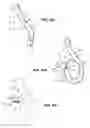 Fig. 15 - Methods and apparatus for revision of obesity procedures