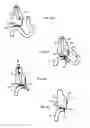 Fig. 16 - Methods and apparatus for revision of obesity procedures