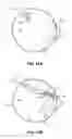Fig. 18 - Methods and apparatus for revision of obesity procedures