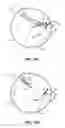Fig. 19 - Methods and apparatus for revision of obesity procedures