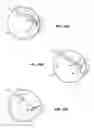 Fig. 21 - Methods and apparatus for revision of obesity procedures