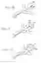 Fig. 04 - Vascular embolization with an expansible implant