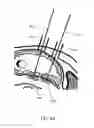 Fig. 18 - METHODS AND DEVICES FOR PERCUTANEOUSLY MODIFYING ORGANS TO TREAT PATIENTS