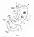 Fig. 20 - METHODS AND DEVICES FOR PERCUTANEOUSLY MODIFYING ORGANS TO TREAT PATIENTS