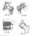 Fig. 03 - Method and devices for minimally invasive arthroscopic procedures
