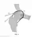Fig. 05 - Method and devices for minimally invasive arthroscopic procedures