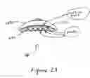 Fig. 04 - Suction retraction surgical instrument