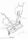 Fig. 06 - Suction retraction surgical instrument