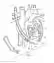 Fig. 06 - Device to permit offpump beating heart coronary bypass surgery
