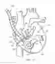 Fig. 10 - Device to permit offpump beating heart coronary bypass surgery