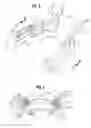 Fig. 04 - OPHTHALMIC SULCUS SPECULUM