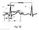 Fig. 03 - ECG signal power vector detection of ischemia or infarction