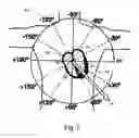 Fig. 04 - ECG signal power vector detection of ischemia or infarction