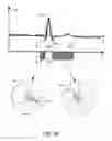 Fig. 06 - ECG signal power vector detection of ischemia or infarction