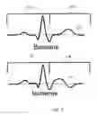 Fig. 14 - ECG signal power vector detection of ischemia or infarction