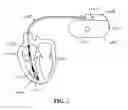 Fig. 18 - ECG signal power vector detection of ischemia or infarction
