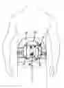 Fig. 01 - Modular compressive orthosis system with a mechanical advantage closure