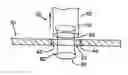 Fig. 01 - Interfacial stent and method of maintaining patency of surgical fenestrations