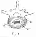Fig. 06 - Magnetic spinal implant device