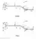 Fig. 03 - ELECTROSURGERY ELECTRODE