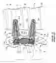 Fig. 06 - Cross-coupled vertebral stabilizers incorporating spinal motion restriction