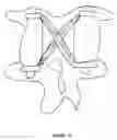 Fig. 08 - Cross-coupled vertebral stabilizers incorporating spinal motion restriction