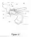 Fig. 04 - Suture retention device