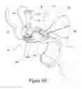 Fig. 05 - Suture retention device