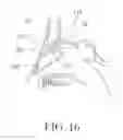 Fig. 10 - Balloon Catheters and Methods for Treating Paranasal Sinuses