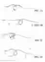 Fig. 02 - Self-looping suture and method of using the same