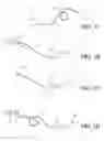 Fig. 04 - Self-looping suture and method of using the same