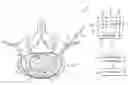 Fig. 01 - Combination electrical stimulating and infusion medical device
