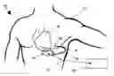 Fig. 01 - Method and apparatus for controlling arrhythmia detection and treatment based on patient posture