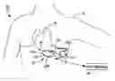 Fig. 01 - Subcutaneous ICD with separate cardiac rhythm sensor