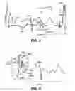 Fig. 06 - Method and apparatus for determining optimal pacing therapy timing intervals