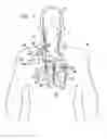 Fig. 02 - Techniques for prevention of atrial fibrillation
